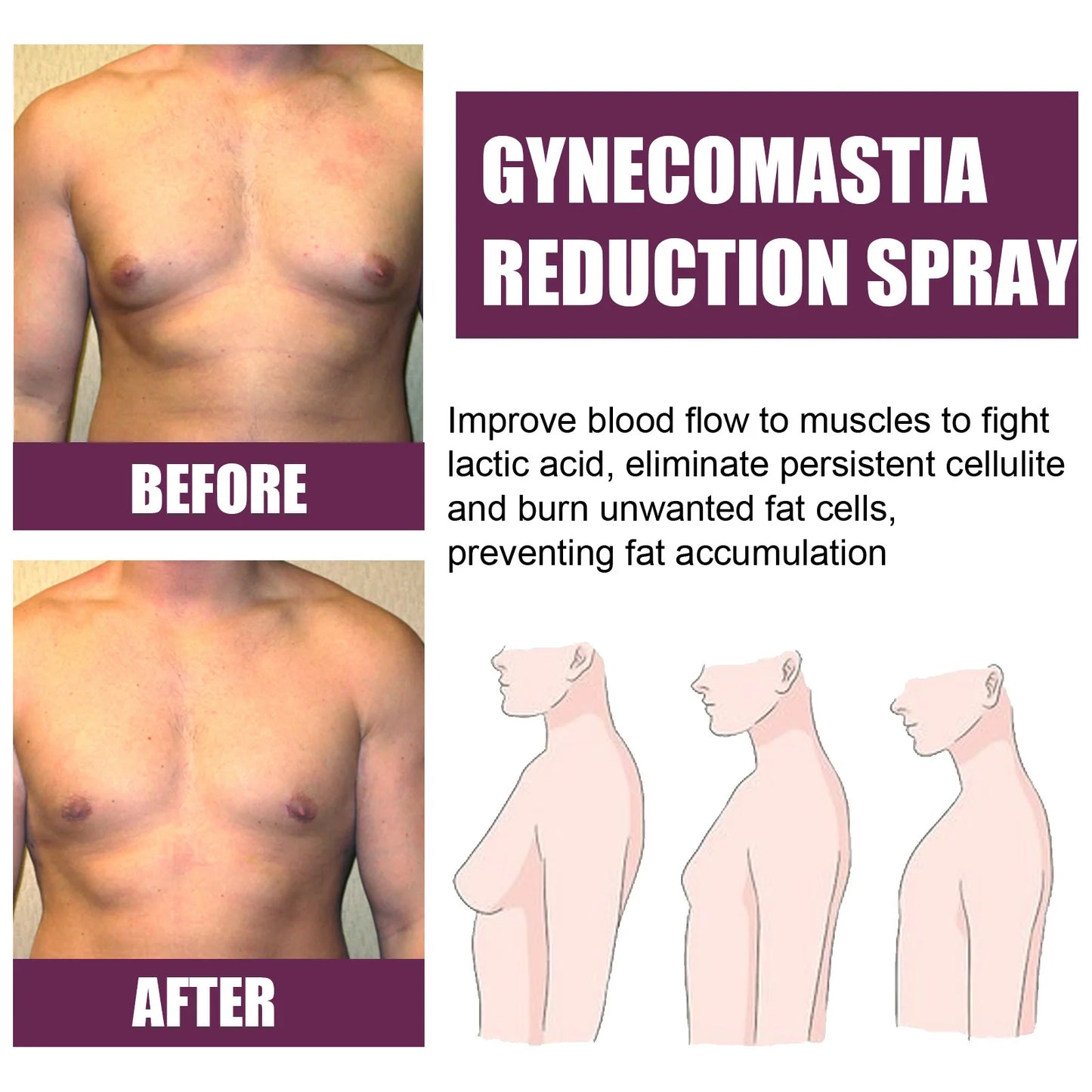 Gynecomastia removal spray